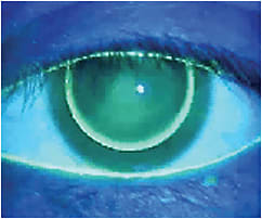 Figure 1. Correct edge clearance (peripheral band of fluorescein) with good lid attachment.