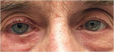 Figure 8. Patient in Figure 7 with a painted iris lens on the right eye.