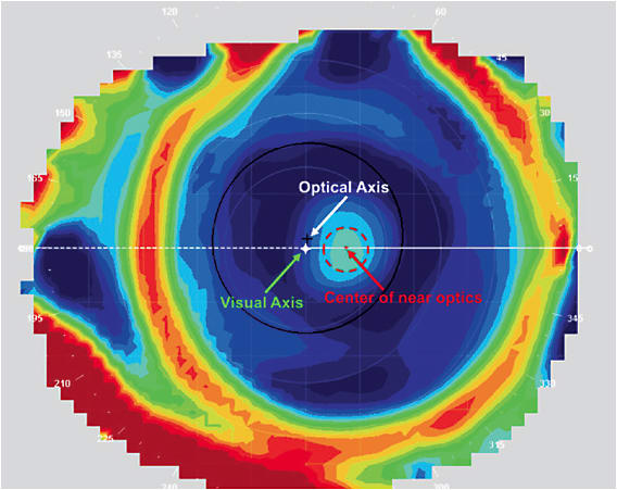 Figure 1. Topography over the lenses was used to evaluate the mismatch between the lens near optics and patients’ visual axis.
Courtesy of Stephanie Ramdass, OD, MS