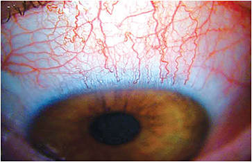 Figure 2. Acute red eye in a SiHy lens wearer.