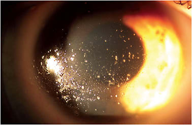 Figure 1. A non-wetting, deposited scleral lens.