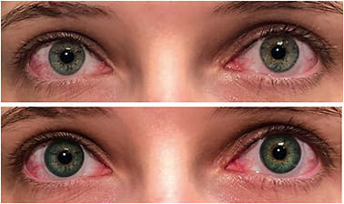 Figure 10. A cosmetic contact lens created a subtle enhancement to brighten and define this person’s light-colored eyes.