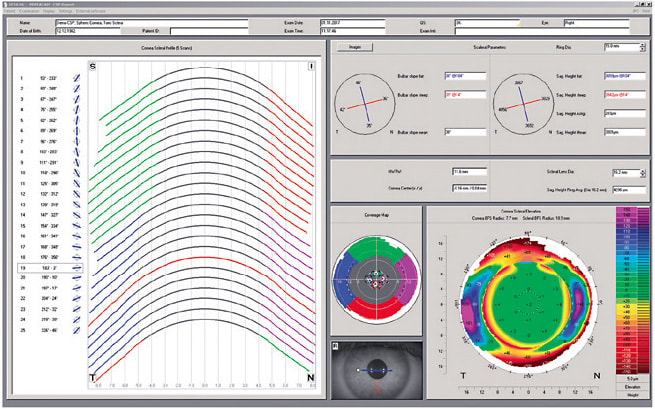Pentacam’s CSP Report measures sagittal height to help facilitate scleral lens fitting.