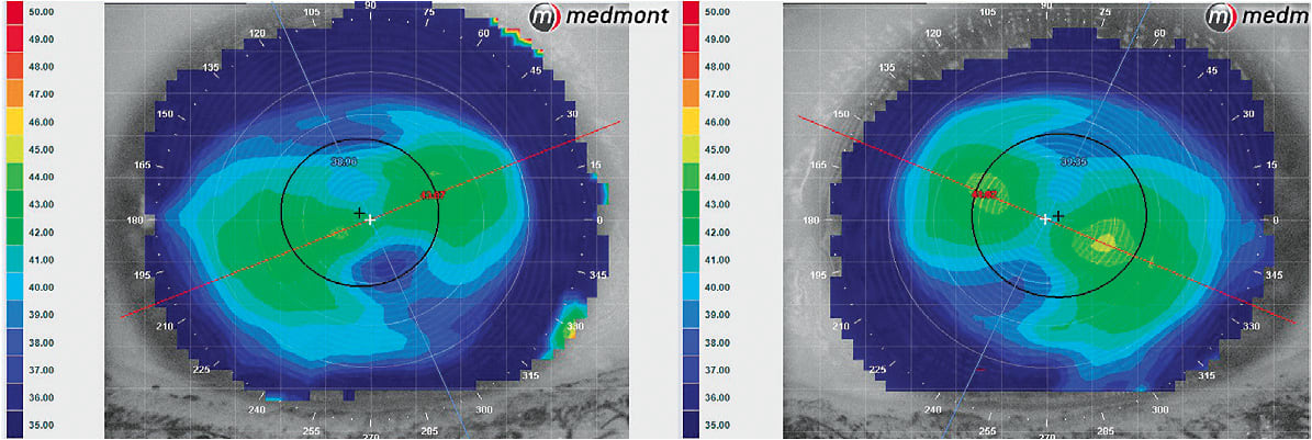 Figure 1. Tamara’s corneal topography (tangential curvature) showing OD 4.91D and OS 4.67D of regular astigmatism.