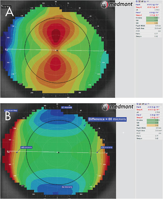 Figure 2. Pre-treatment axial map showing 3.75D of central with-the-rule astigmatism (A) and elevation map (B). This example shows an 88-micron elevation difference between the vertical and horizontal landing points.