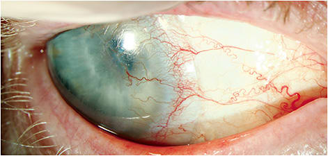 Figure 5. A new patient presenting for scleral lens refitting with incidental findings of neovascularization growth reaching the donor graft.