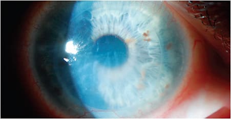 Figure 9. Endothelial rejection post-corneal graft with presentations of stromal edema, stromal folds, and endothelial keratic precipitates.
Courtesy of Christopher Rapuano, MD