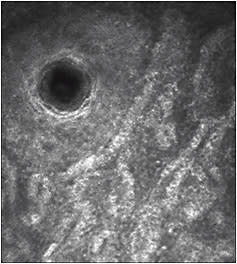 Figure 3. The meibomian gland orifice is visible in the top left corner with the surrounding epithelial cells. The meibomian gland acini are visible surrounding that. © Brien Holden Vision Institute 2017. Reproduced with permission. Please contact the Brien Holden Vision Institute via www.brienholdenvision.org for further information.
Courtesy of Dr. Waleed Alghamdi and Professor Eric Papas
