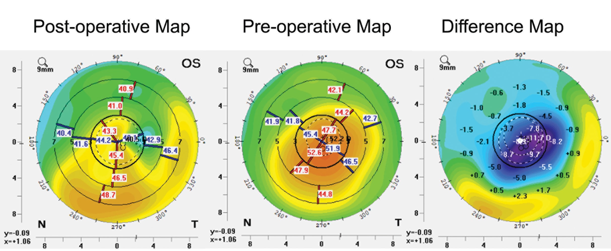 Custom-shaped trephine-cut CAIRS for post-LASIK ectasia: Preoperative map (middle), postoperative map (left) and difference map (right) corneal topography maps showing good flattening, evening, regularization, and centralization of the cone.