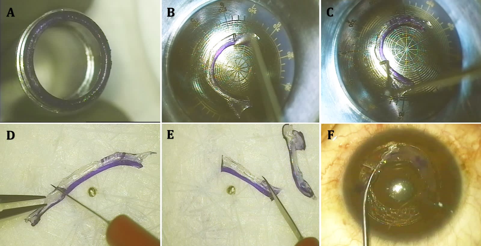 Custom shaped trephine-cut CAIRS for post-LASIK ectasia: A: The CAIRS segment is cut using a double-bladed trephine. B,C: It is customized using the CAIRS customizer; D,E: The custom shape is easily cut using a side-port blade; F: The CAIRS segment is easily introduced into the channel.