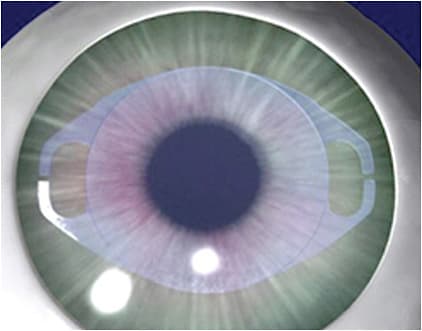 Verisyse IMAGES COURTESY OF JOHNSON & JOHNSON VISION.