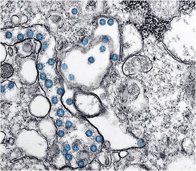 Transmission electron microscopic image of an isolate from the first U.S. case of Covid-19. PHOTO: CDC