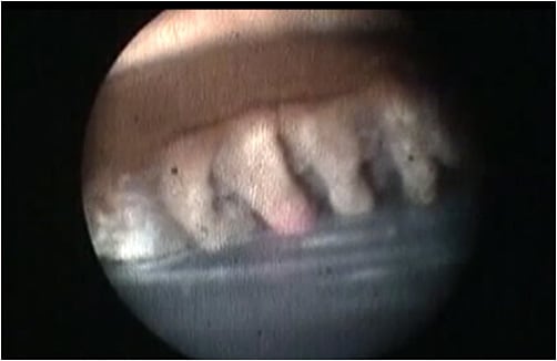 Figure 2. Plateau iris seen through the endoscope.