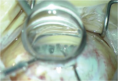 Figure 4. Microforceps-assisted goniosynechiolysis. Photo courtesy of Dr. Chang