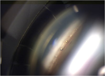 Figure 1. Postoperative appearance from an excimer laser trabeculostomy.