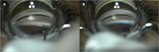 Figure 3. OMNI surgical device (Sight Sciences) with the microcatheter advancing into Schlemm’s canal. Photo courtesy of Dr. Chang