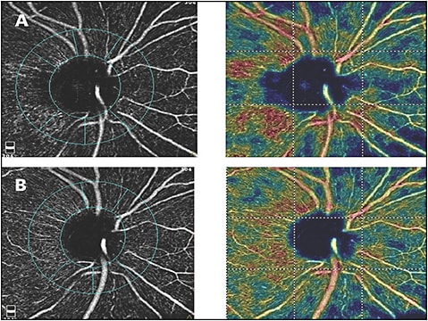 Figure 2. OCTA scan (Avanti with AngioVue; Optovue) of an optic nerve head vessels before (A) and 1 month after glaucoma surgery and restoration of physiologic IOP (B).
