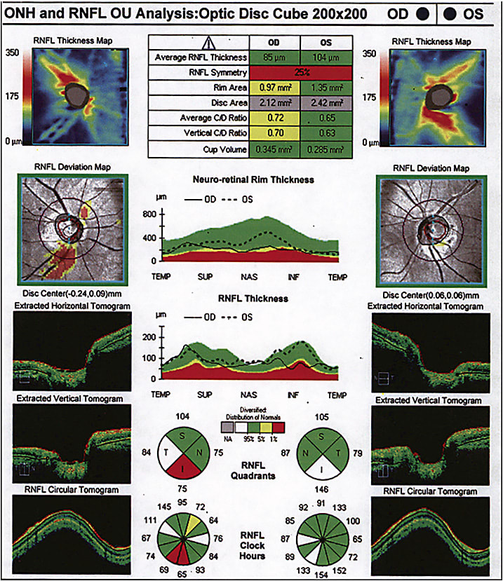 Figure 5. Optical coherence tomography from 2016 of a 59-year-old Asian male, demonstrating little change.