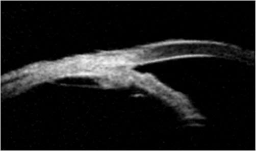 Figure 3: Postoperative ultrasound biomicroscopy showing open angle, deep anterior chamber, and flattened ciliary processes.
