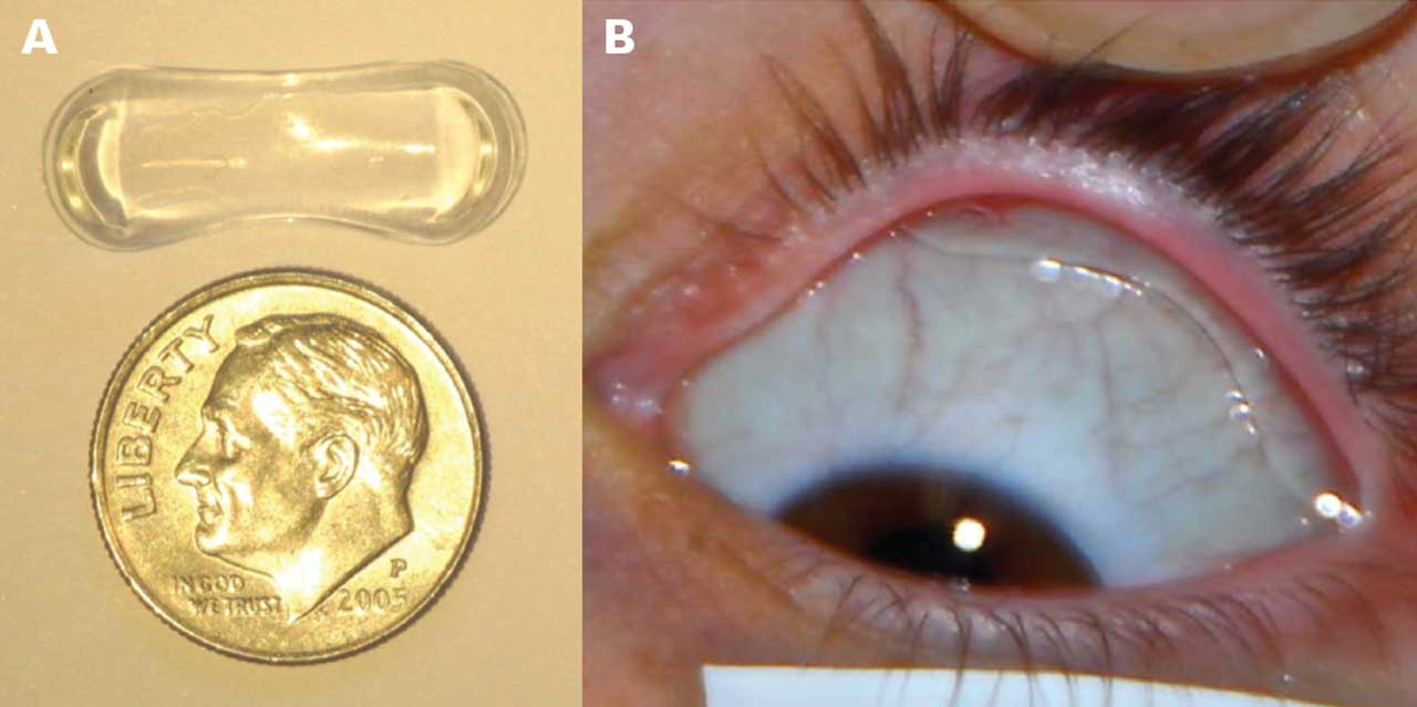 Figure 1. The Topical Ophthalmic Drug Delivery Device (Amorphex). The device in comparison to a dime (A) and the device placed under the eyelid to deliver drug.