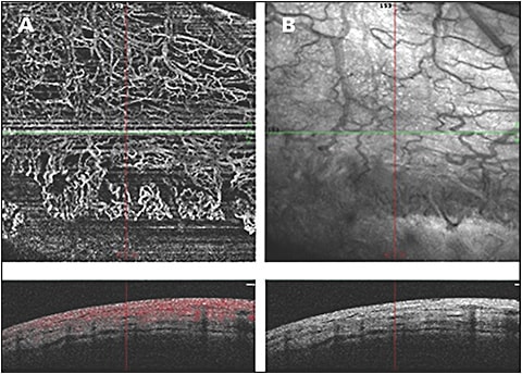 Figure 4. OCTA scan (A) (Avanti with AngioVue; Optovue) and photograph (B) of a filtration bleb 1 week after deep sclerectomy.