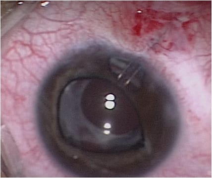 Figure 3. In an eye with glaucoma following cataract surgery, Ahmed Glaucoma Valve (New World Medical) implantation was performed with the intrascleral tunnel technique, and tube exposure developed 5 years later. The tube was inserted very close to the cornea and led to localized corneal edema.