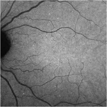 Figure 1. Detection of apoptosing retinal cells image identifying apoptosing retinal ganglion cells as hyperfluorescent bright spots after injection of annexin ANX776.