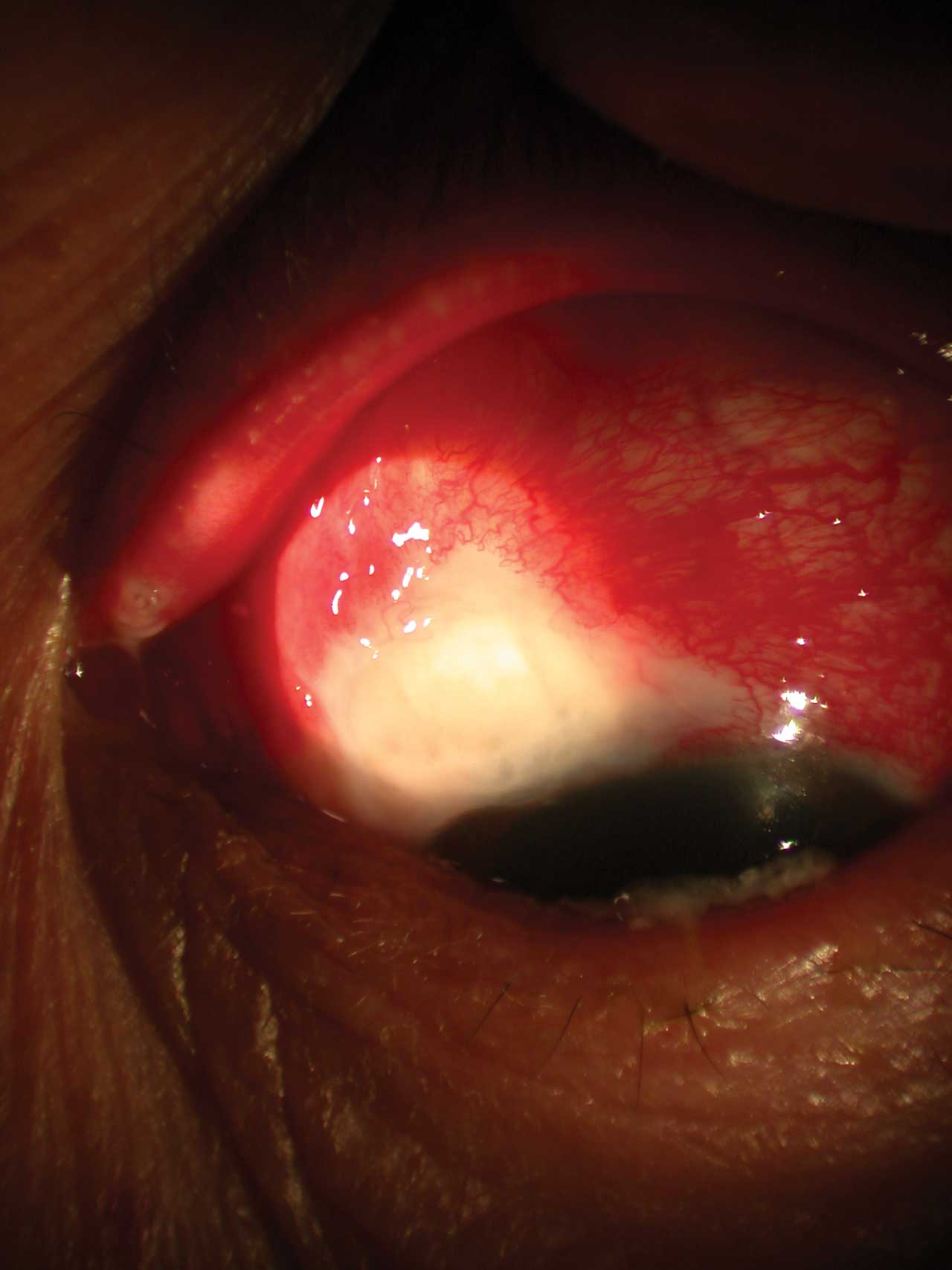 Figure 1. Blebitis can develop at higher rates in mitomycin C‒treated eyes.