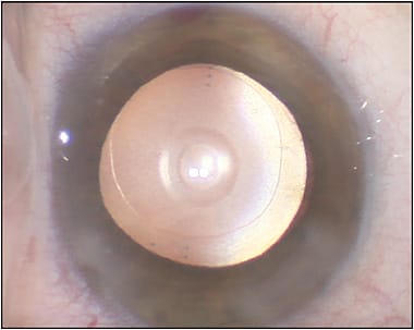 Figure 2. The patient received the Alcon Vivity EDOF lens and iStent Inject from Glaukos in both eyes.