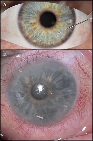Figure 1. Depiction of procedure to inject the Durysta sustained-release implant (Allergan) (A). Related video is available at www.glaucomaphysician.net . Clinical image of properly placed Durysta implant (B). Images courtesy of Allergan.