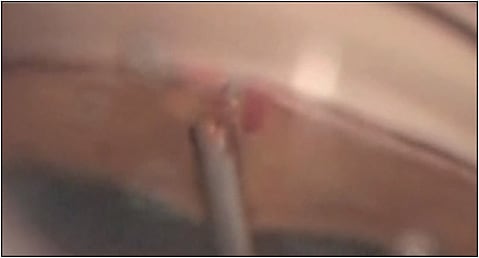 Figure 1. Blood emanating from an iStent (Glaukos).