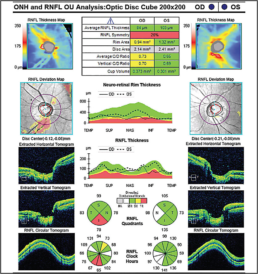 Figure 3. Optical coherence tomography from 2019 showing focal loss of nerve fiber layer in a 59-year-old Asian male.