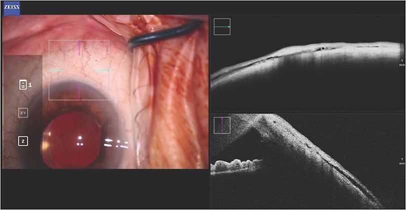 Figure 1. Zeiss Artevo 800 with intraoperative optical coherence tomography demonstrating dilation of the collector system with improved aqueous outflow following an Omni canaloplasty procedure (Sight Sciences).