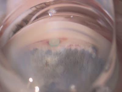 Figure 2. Correct placement of iStar Medical's Miniject biointegrating supraciliary MIGS. Courtesy of Chrys Dimitriou at Colchester Eye Centre, UK.