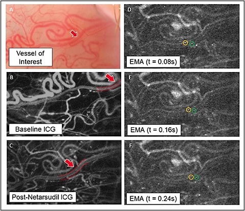 Figure 3. Erythrocyte-mediated angiography is a technique in which autologous fluorescently labeled erythrocytes are reinjected into a human subject, enabling precise quantification of flow rates. The color photograph (A) shows an episcleral vessel.