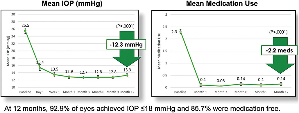 Figure 2. In a 12-month retrospective study of Kahook Dual Blade (New World Medical) excisional goniotomy and goniosynechialysis combined with phacoemulsification for angle-closure glaucoma, 92.9% of eyes achieved IOP of less than or equal to 18 mmHg, and 85.7% were medication free.12