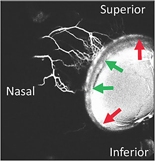Figure 2. Segmental aqueous humor outflow. Aqueous angiography in a live glaucoma patient shows segmental postlimbal angiographic outflow. Superonasally, outflow is seen (green arrows). Inferonasally, no outflow is seen (red arrows).