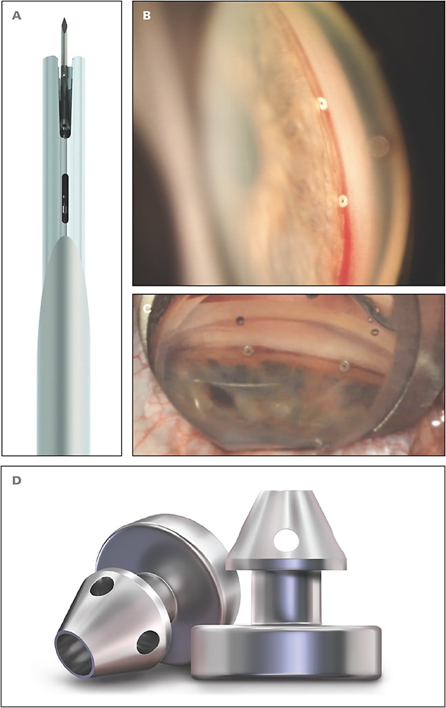 Figure 1. Surgeons use the iStent inject W (Glaukos) injector system (A) to deliver iStent inject W stents to create 2 patent bypass pathways through the trabecular meshwork (B, C). The iStent inject has a wider flange (D) than its predecessor the G2.