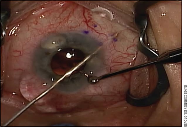 Figure 2. Intraoperative photograph demonstrating the tip of the injector exiting the scleral wall and tenting up the conjunctiva. Note that the tip is exiting roughly 2 mm posterior to the limbus.