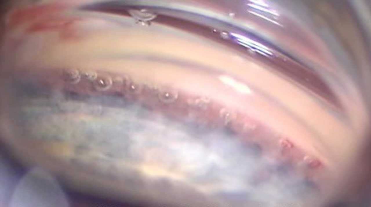 Figure 2. In an excimer laser trabeculostomy procedure, the excimer laser creates tiny channels in the trabecular meshwork. Image courtesy Steven R. Sarkisian Jr., MD.