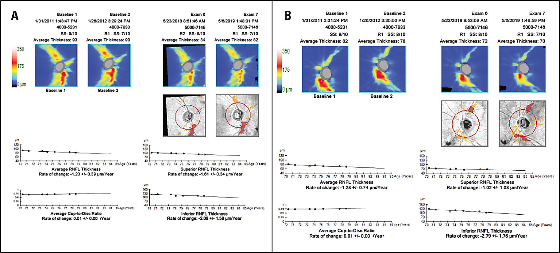 Figure 6. Slow progressive loss of nerve fiber layer over time in a 78-year-old white male OD (A) and OS (B).
