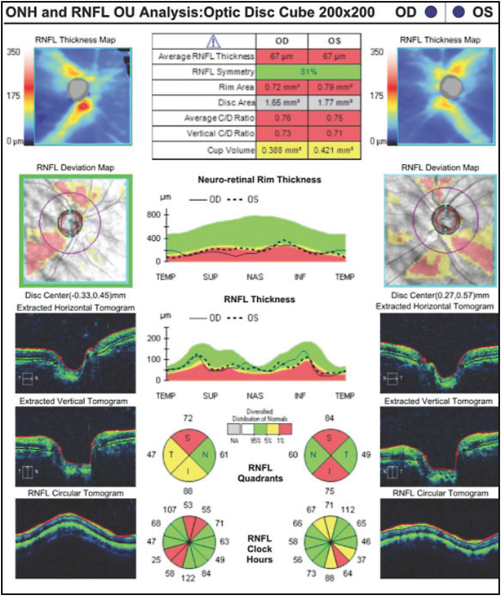 Figure 1. A 54-year-old female patient presented with a cup-to-disc-ratio of 0.8 in both eyes, and ancillary testing revealed significant retinal nerve fiber layer deficits on OCT of both eyes, consistent with anatomically advanced glaucoma.