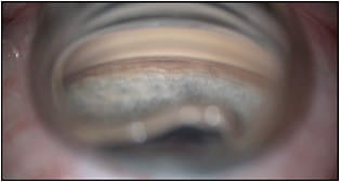 Figure 1. A cyclodialysis of 1 to 2 clock hours seen on intraoperative gonioscopy (iPrism; Glaukos) in a patient where goniotomy was attempted. The trabecular meshwork is untouched; however, the operating surgeon likely opened up the cyclodialysis cleft when they targeted the ciliary body band for goniotomy due to a misread landmark.