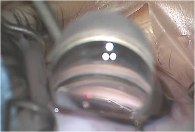 Figure 2. Gonioscopy-assisted transluminal trabeculotomy with an iTrack catheter (Nova Eye Medical). Photo courtesy of Dr. Chang