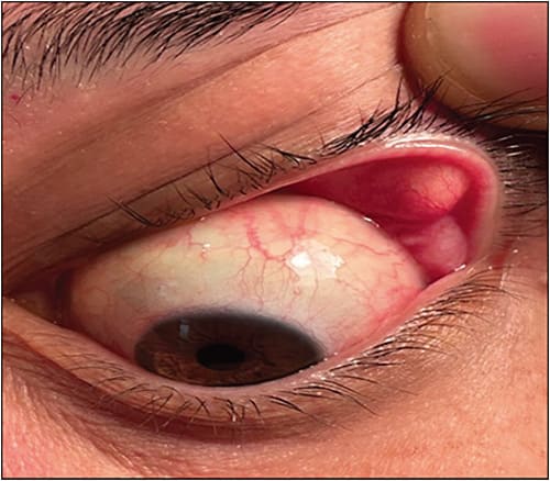 Figure 1. The presence of floppy eyelid syndrome is a surprisingly sensitive screening tool for obstructive sleep apnea. Image courtesy of Matthew Brink, MD.