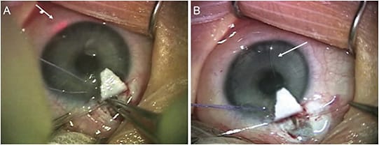 Figure 2. In ab-externo trabeculotomy, once Schlemm’s canal is identified, the catheter is introduced into 1 cut end of Schlemm’s canal and then gradually advanced circumferentially, using the illuminated tip as confirmation of the position within the canal.
