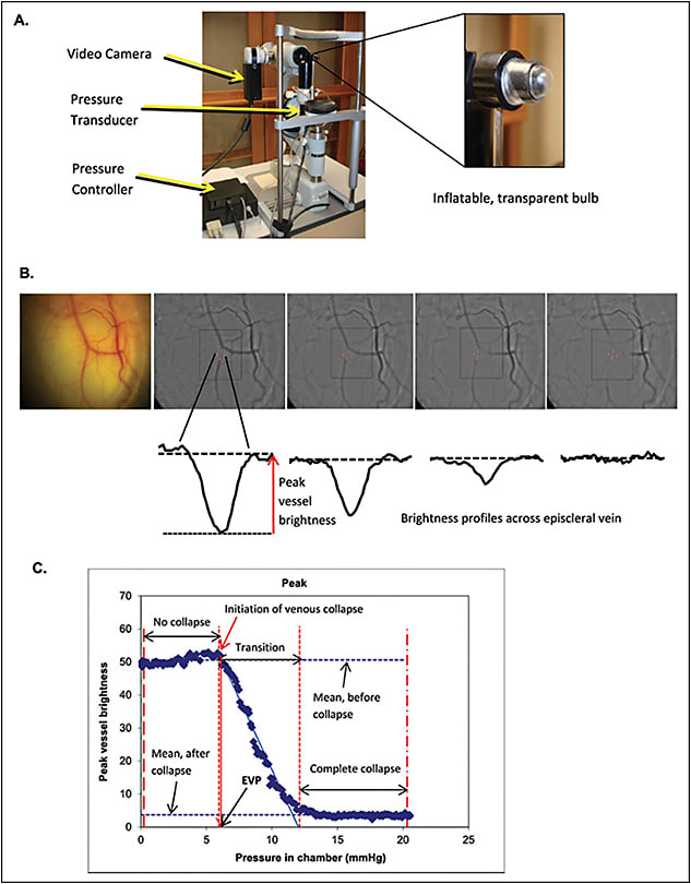 Figure 1. One way to measure episcleral venous pressure (EVP) is with an episcleral venomanometer mounted on a slit lamp (A). As pressure on the veins increases, a video camera is used to