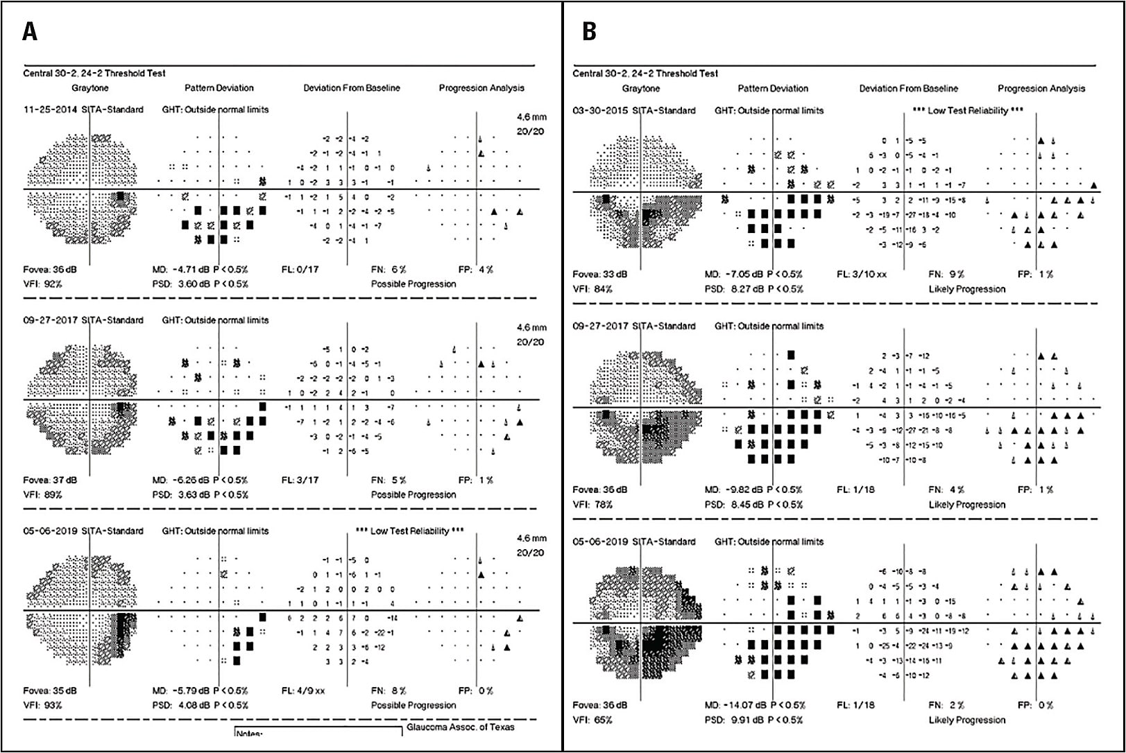Figure 7. Slow progressive Humphrey visual field loss over time in a 78-year-old white male OD (A) and OS (B), consistent with the area of progressive thinning on optical coherence tomography.