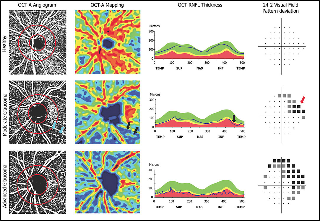 Figure 1. OCTA scans (left) (Avanti with AngioVue; Optovue), OCT RNFL thickness curve (middle) and automated visual field pattern deviation (right) of patients with a healthy optic disc (top), and showing moderate (middle) to advanced (bottom) glaucomatous defects. The correspondence in defects across the 3 tests is shown for the case of moderate glaucoma.