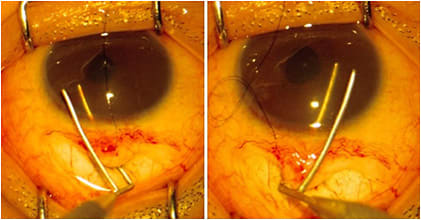 Figure 1. In ab-externo trabeculotomy, the probe is advanced into each end of Schlemm’s canal up to the joint (about 60º) and gently rotated into the anterior chamber through the trabecular meshwork. Any resistance indicates false passage, and the probe should be withdrawn and repositioned.